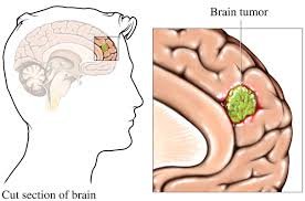 brain tumor symptoms in urdu